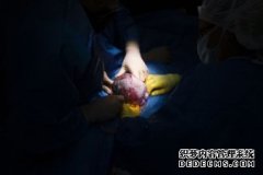 研究发现剖腹产生的婴儿更易有健康问题