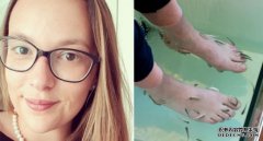 澳女子度假时体验鱼疗导致感染 五个脚趾被切除