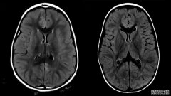 抗NMDA受体脑炎的诊断：翻转了一名高中生的命运