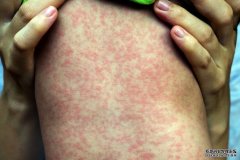新州昆州发布麻疹警报