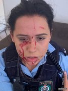 悉尼女警执行任务期间遭人咬伤脸部（慎入）