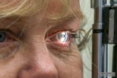 眼部扫描识别老呆早期迹象进入临床试验
