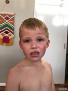 5岁男孩在家中后院遭到袋鼠攻击