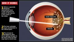 墨尔本将进行世界首创，可能治愈导致失明的老