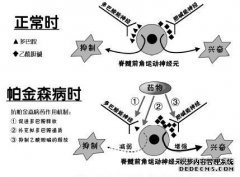 研究称找到帕金森症病因 阻止病情发展仍需时日