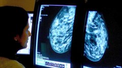 慈善组织拨款乳癌研究旨在10年内消灭乳癌死亡