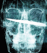 NZ最命大的男子 匕首穿脑 X光片上十分吓人