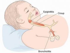 亲历CROUP，CROUP(喉炎）知识普及贴