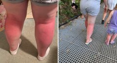 澳洲家庭海滩度假被灼伤 Woolworths防晒霜品质遭质