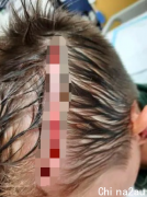澳洲6岁男孩无端遇袭，头部留下可怕伤疤！这一