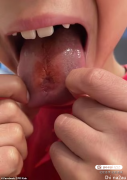 停止食用：多人舌头被烧出洞，澳洲当局警告“吃它”危险性太高！