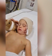 一个月内九起狗咬人！昆州男童脸部撕裂伤送医！