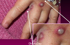 悉尼又一男子感染猴痘，全澳已确诊3例！卫生官：不太可能变成大流行病，但网友表示：得了可能生不如死！