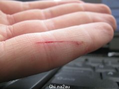 可怕！澳洲男子不小心划破手指，一条怪异的线就在他手臂蔓延开...