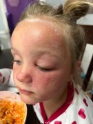 这种杂草“不好惹”，澳洲大部分地区都有！6岁女孩闻后脸上泛起皮疹（组图）