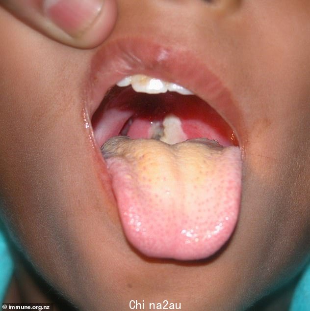 Symptoms of the disease depend on the site of the infection, with the most severe forms of the infection affecting the throat and tonsils