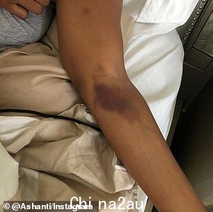 Horrific: 帖子显示了瘀伤的道格拉斯遭施虐者之手” class=