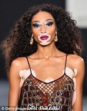加拿大时装模特 Winnie Harlow 是已知的白癜风患者