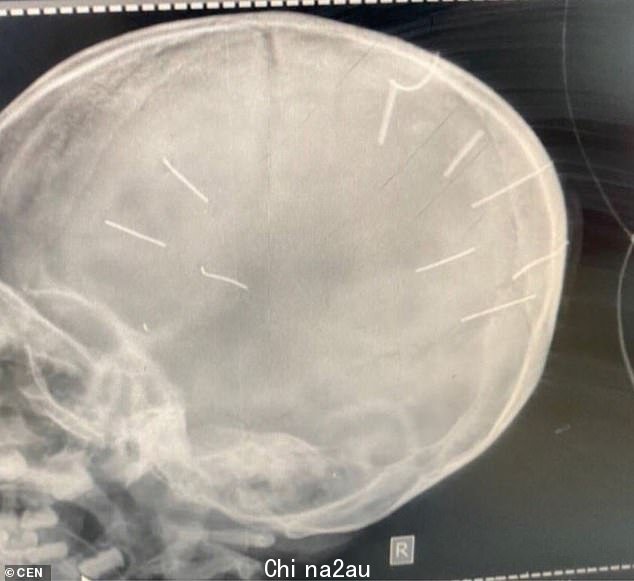 越南一家法院判处一名男子死刑,罪名是用钉子钉入女友的三岁女儿的头部,令人震惊地谋杀了她。图为:该女孩的医院 X 光照片受伤,在她的头骨内露出九个钉子