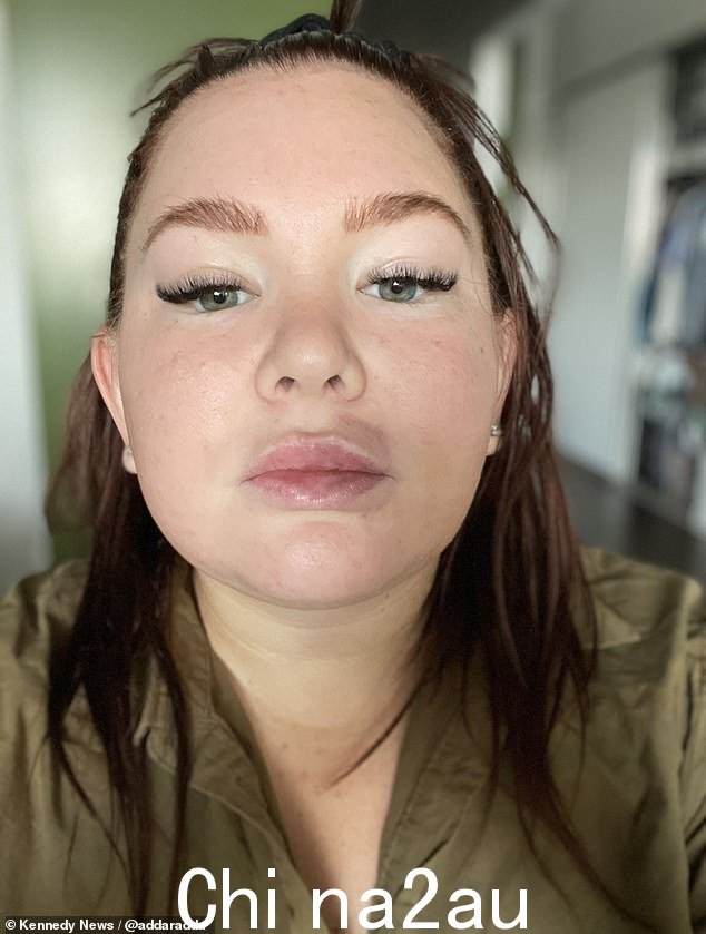 Adriana 的肿胀开始消退,但她的嘴巴和嘴唇周围留下了持续一周的瘀伤