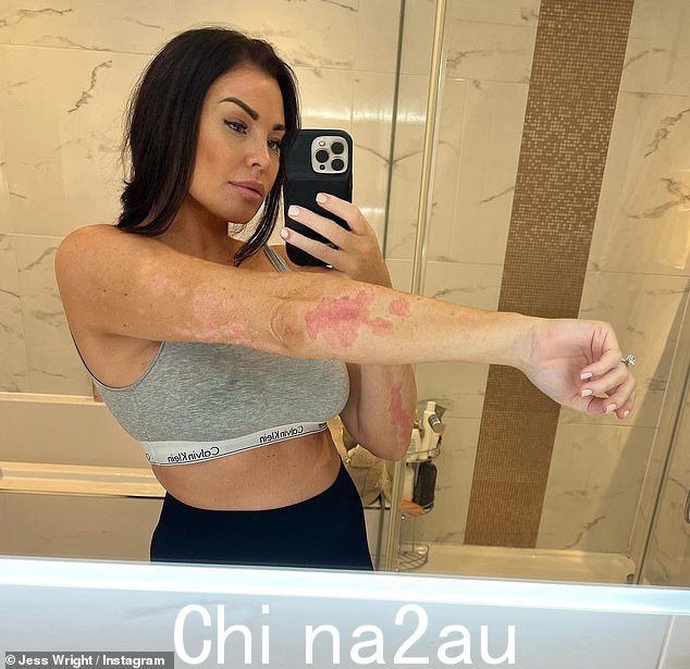 Brave: Jess Wright 透露她的牛皮癣让她感觉“真的很c**p”并且它“在精神上造成了损失”-在她的儿子 Presley 于 6 月出生后症状恶化后