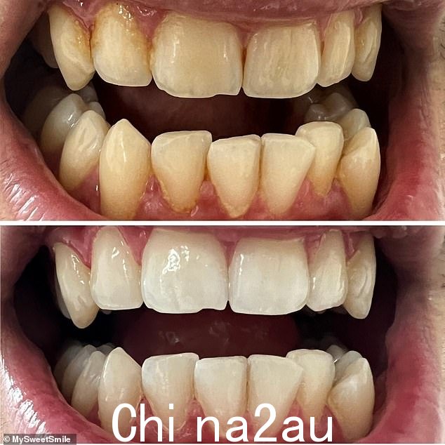 为获得最佳效果,我们建议搭配美白牙膏或美白粉,以帮助延长和增强效果