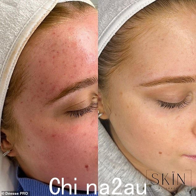一位顾客在 Skin By Grace 完成 LED 治疗的前后对比
