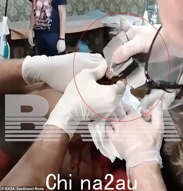 外科医生扭动炮弹的尾巴试图将其从受伤的士兵身上取出,他们担心它可能会爆炸