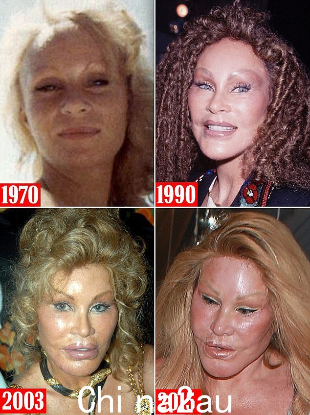 Wildenstein 因其夸张的猫科动物特征而获得了“猫女”的绰号,随着时间的推移,这些特征变得更加明显
