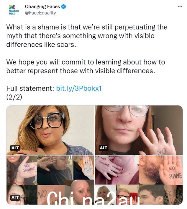 'Shocking':Charity Changing Faces 在他们的 Twitter 页面上写了关于'令人震惊'的插曲:'亲爱的@BBC 和@OnlyConnectQuiz。看到 sca,我们感到失望和震惊rs 最近在你的节目中被描述为“耻辱的标志”。 #NoSham in having a scar'