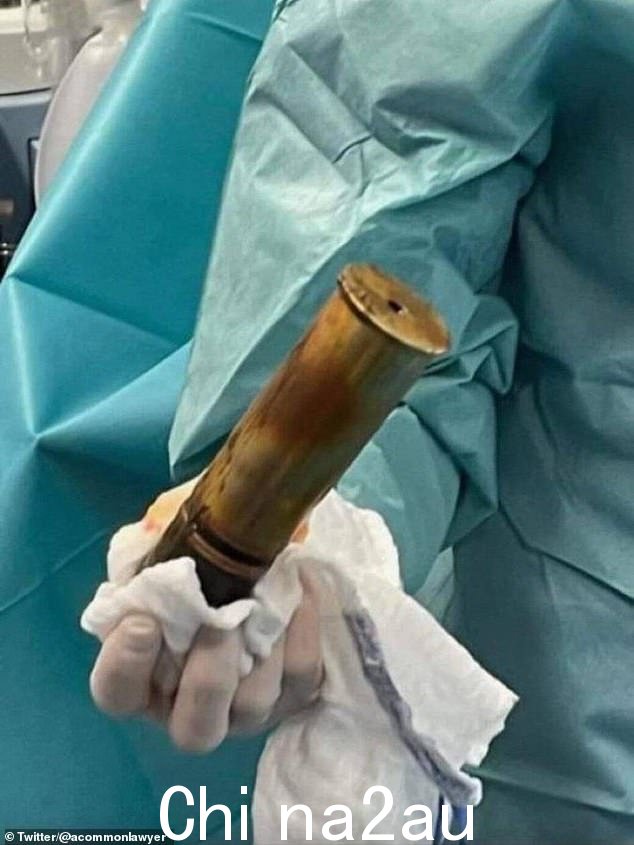 一旦它从男人的直肠中脱落,医生就测量处理了 8 英寸长(20 厘米)和超过 2 英寸宽(5 厘米)的外壳。事件发生在法国南部土伦的圣穆斯医院,周六晚上
