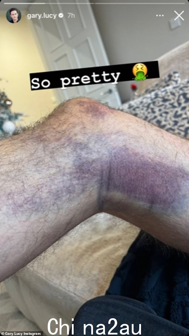 'So pretty': The Celebs Go Dating star, who has in a new relationship with Love Islander Laura, shared a picture of his injuries with his followers