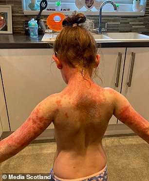 接受 Strep A 后,Khloe 得到了红色的'从头到脚皮疹'