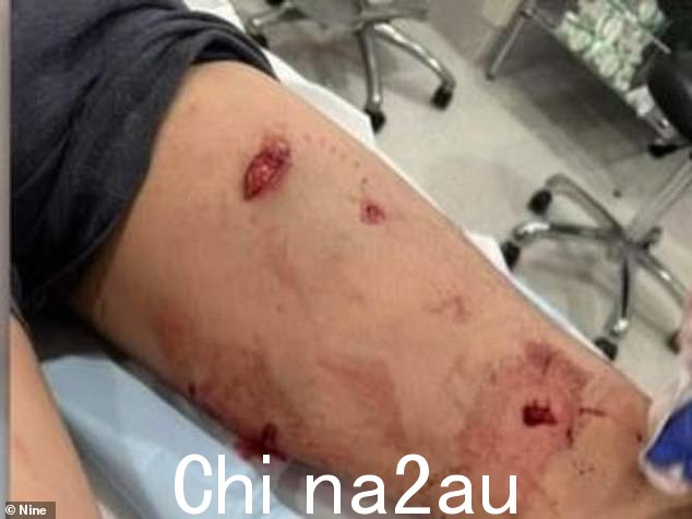 陈先生因伤不得不住院治疗两个晚上(如图)