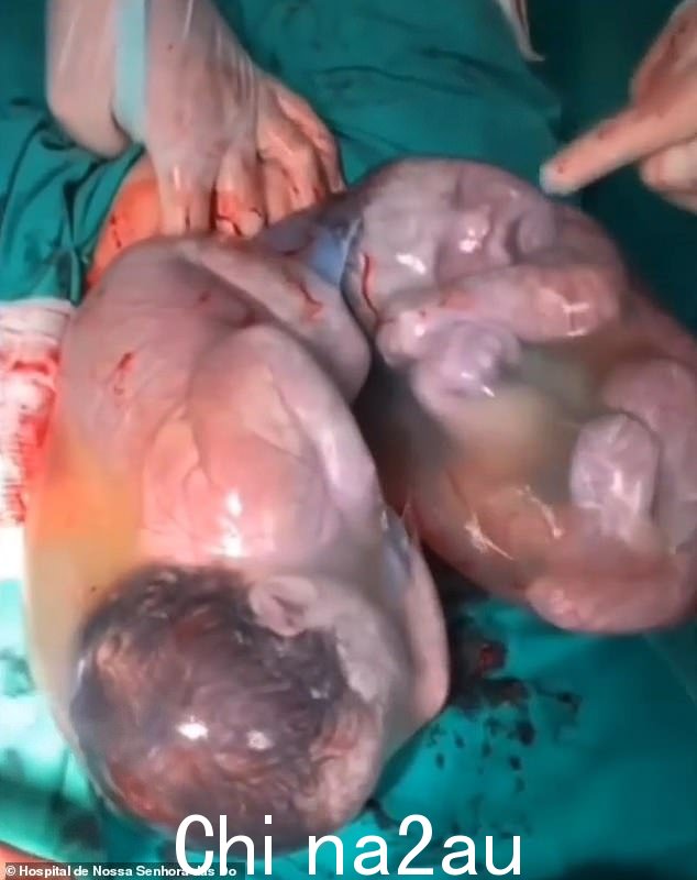 2022 年 6 月 11 日,巴西 Ponte Nova 的 Hospital de Nossa Senhora das Dores 剖腹产后,双胞胎 Maria Cecilia 和 Maria Alice 在羊膜囊内
