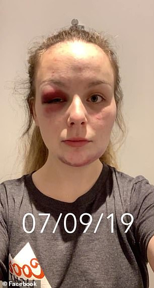 这名 22 岁的年轻人在社交媒体上发布的照片声称显示了虐待造成的伤害(如图),但这些照片被发现是自己造成的