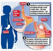 植入胃中的硅胶“乒乓球”如何缓解慢性胃灼热