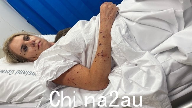 Elmarie Steenberg 躺在黄金海岸大学医院的病床上布满鲜血和弹片的伤口。图片:已提供。