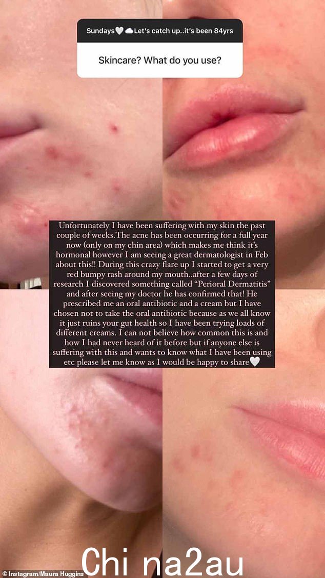 哇:32 岁的前爱岛美女,在 Instagram 上公开谈论皮肤病,嘴巴周围出现皮疹,会导致发红、小肿块、脱屑和瘙痒