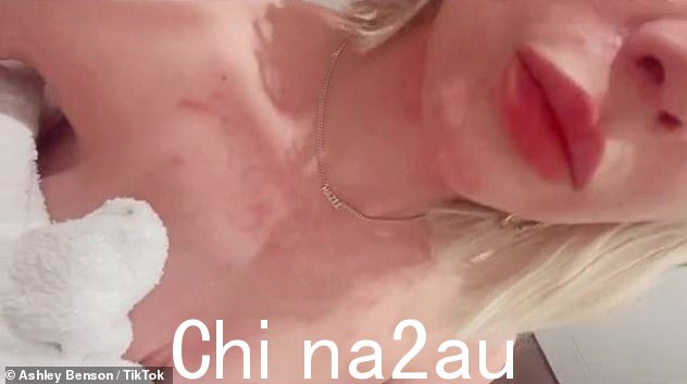 皮肤状况:这是在 Ashley 在新的 TikTok 视频中坦诚地讲述了她心理健康问题的影响之后