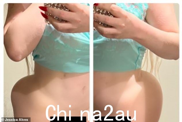 哎哟!杰西卡最近透露,她的臀部植入物在她仍在手术恢复期间起床过早后变得“移位”