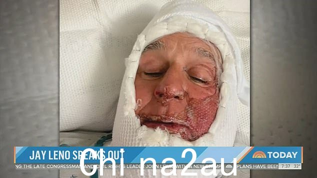 一位医生为这位明星进行了皮肤移植,去除了他的臀部rnt 皮肤并用皮肤库中的皮肤替换它