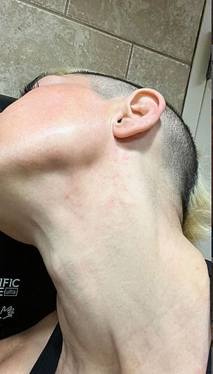 麻木:Kortney Olson 在恶毒的耳光打斗后露出肿胀和发红的脖子