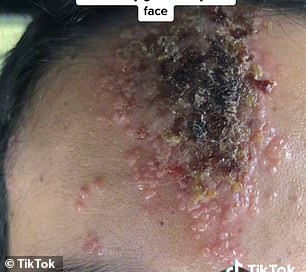After: 伤口越来越严重,原来是疱疹引起的巨大唇疱疹