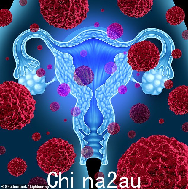 卵巢癌研究联盟鼓励已经生完孩子并且已经“接受盆腔手术”的女性切除输卵管(库存图片)