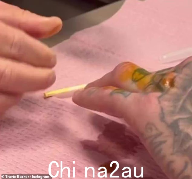 止痛药:医生通知鼓手他的手指可能撕裂了一些东西