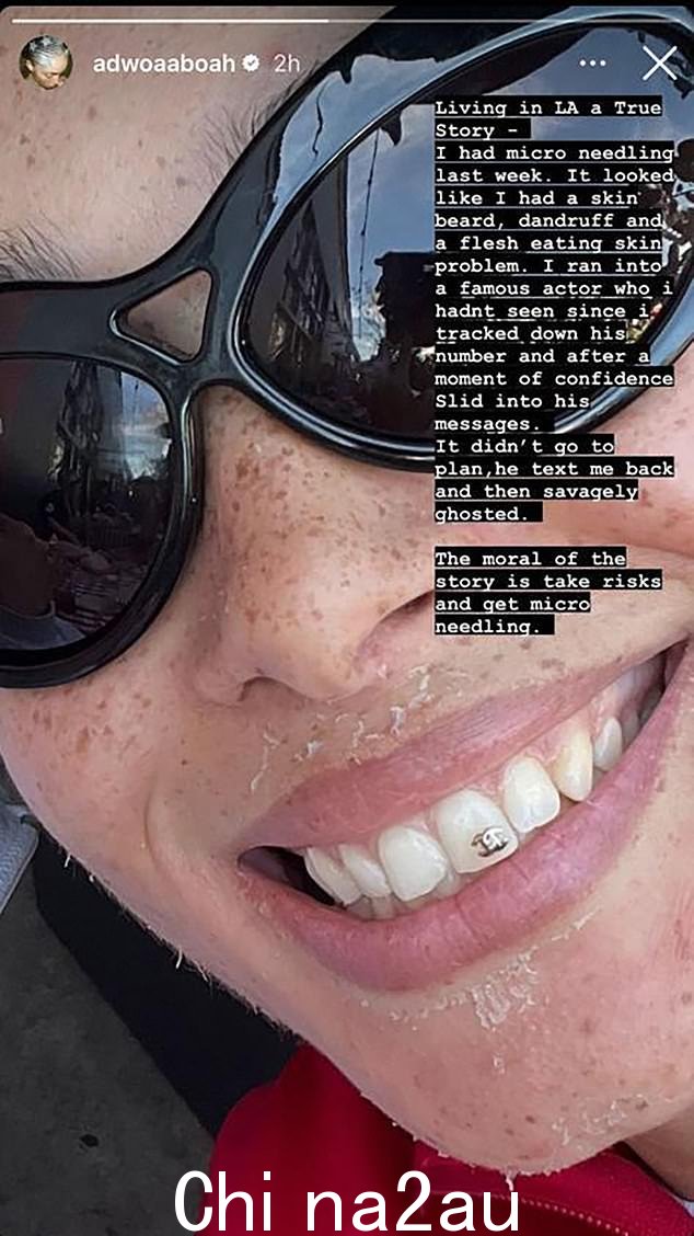 她承认在接受了一种名为微针的昂贵皮肤治疗后,她并没有看起来最好,这种治疗涉及用细针刺破皮肤以刺激胶原蛋白。 “我看起来像是有食肉皮肤问题,”她解释说“class=