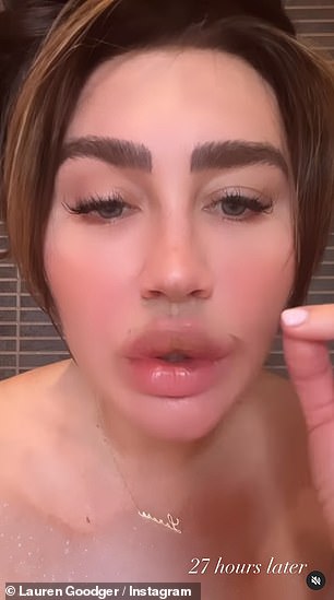 Reveal: Lauren 还发布了以前的照片,上面的胶带覆盖了她嘴唇的各个部分,主要是围绕着它们的圆周,在她的丘比特弓和下唇的中心