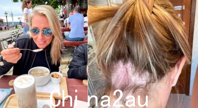 上图是一名据称使用了 Olaplex 护发产品并因此脱发的女性,由 Amy Davis 法律中心提供