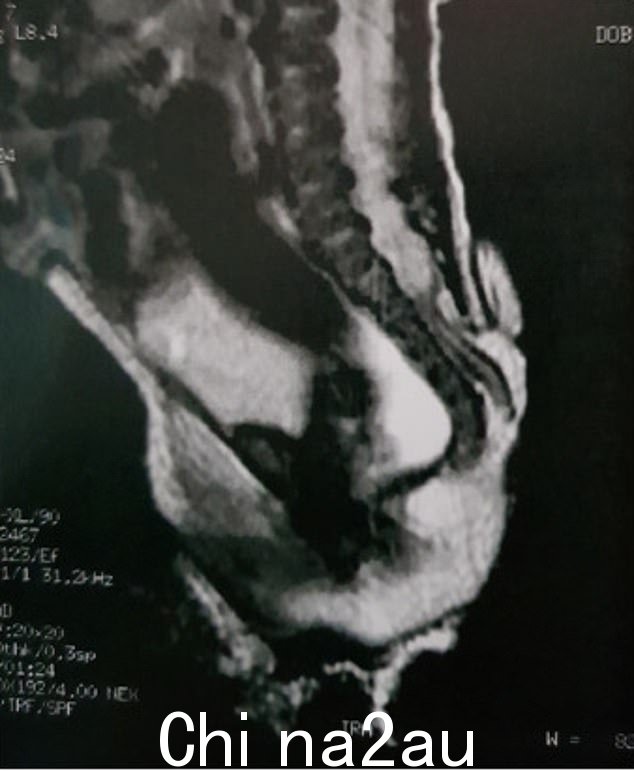 据小儿外科病例报告杂志发表的报告,体检发现腰骶部长出一条6cm长的皮肤覆盖的软组织尾巴